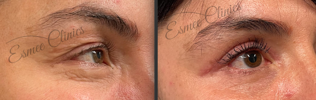 Before and After img